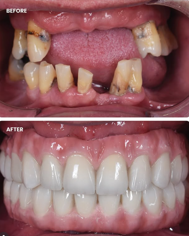 Before and after Full Mouth Rehabilitation at Summirow Dental Clinic