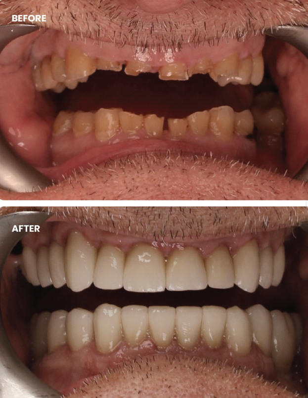 Before and after Smile Design with veneers