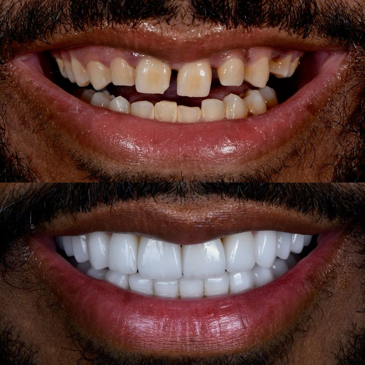 Before and after Veneers + Bite Correction
